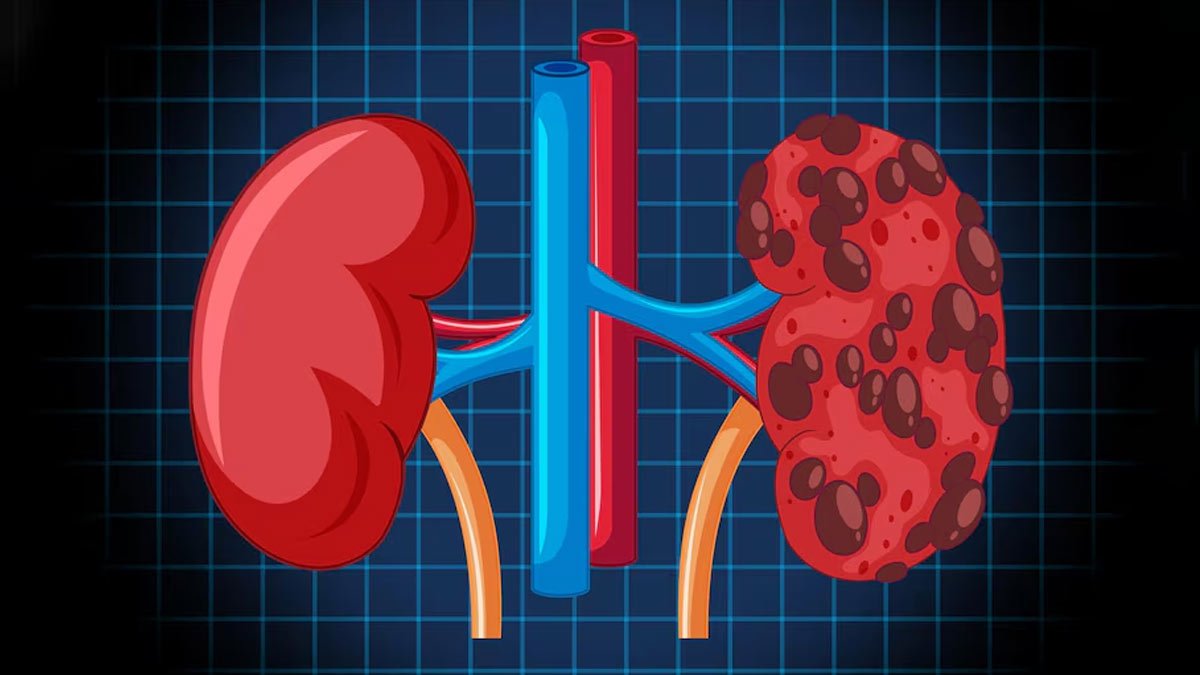 kidney-stones